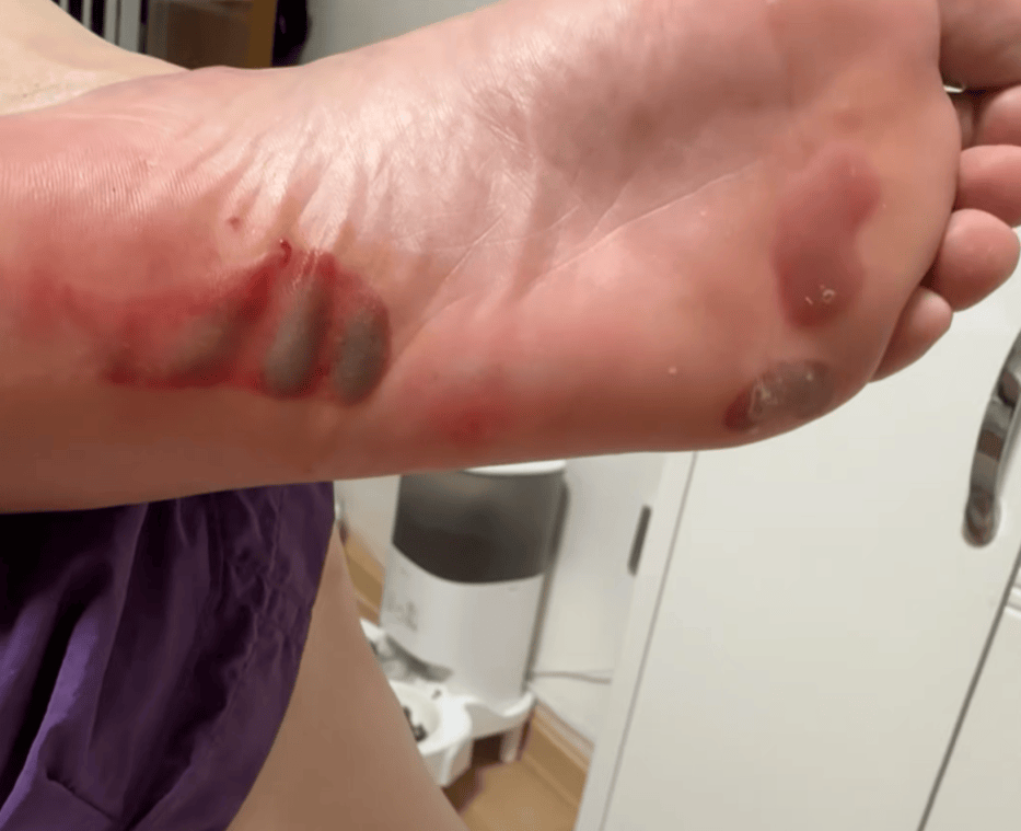 “月瘦20斤”“很多人都在用”<strong></p>
<p>西鳳酒
</strong>！女子在家跟練突然腳底噴血……:西鳳酒
