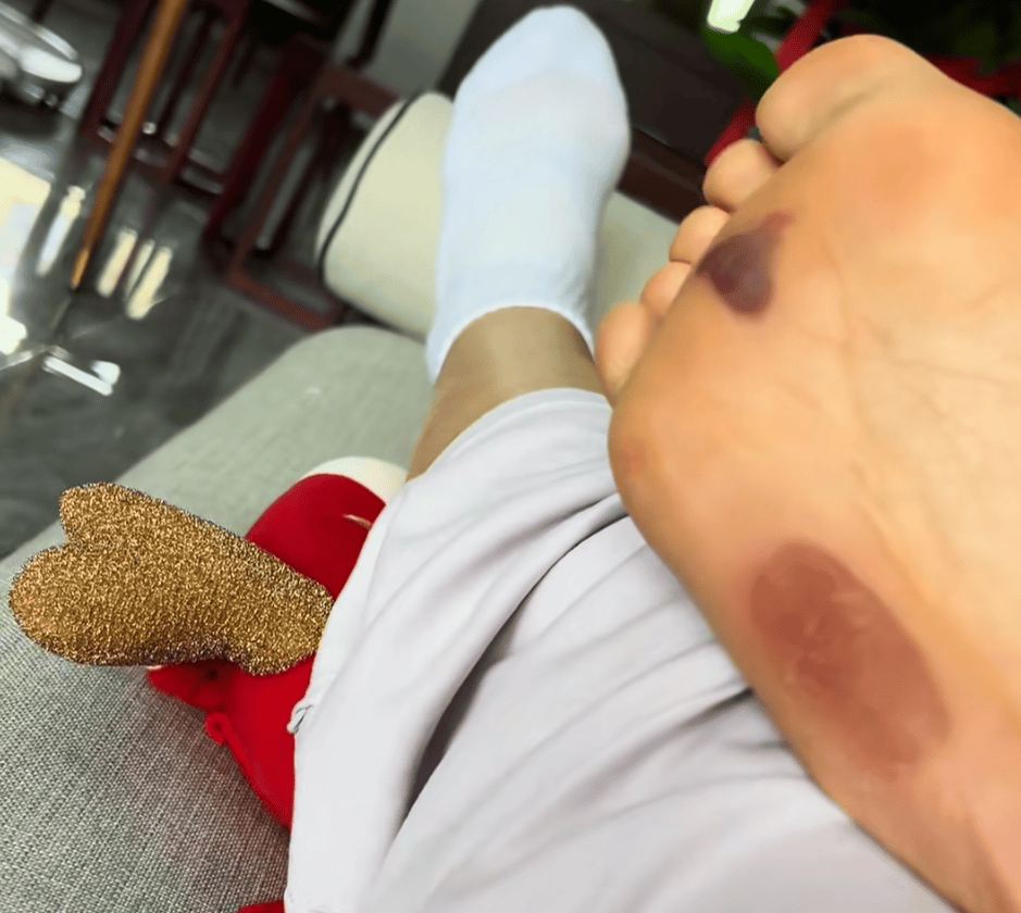 “月瘦20斤”“很多人都在用”<strong></p>
<p>西鳳酒
</strong>！女子在家跟練突然腳底噴血……:西鳳酒
