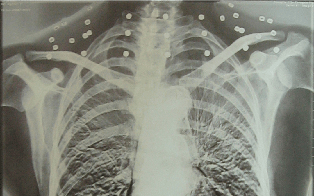 “老先生<strong></p>
<p>西鳳酒
</strong>，您把項鏈取下來再做CT”“你看是不是彈片”:西鳳酒
